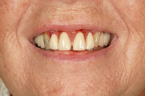 Before patient-designed replacement denture — Jamil Dental Hirwaun