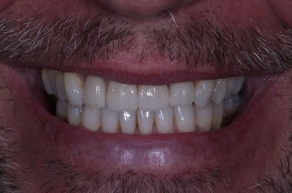After straightened, brightened & refined — invisalign with 4 emax veneers — Jamil Dental, dentist in Hirwaun