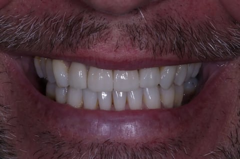 After straightened, brightened & refined — invisalign with 4 emax veneers — Jamil Dental Hirwaun
