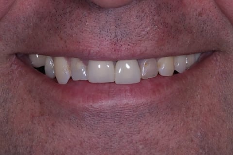Before brighter & balanced — whitening with emax crowns & veneers — Jamil Dental Hirwaun