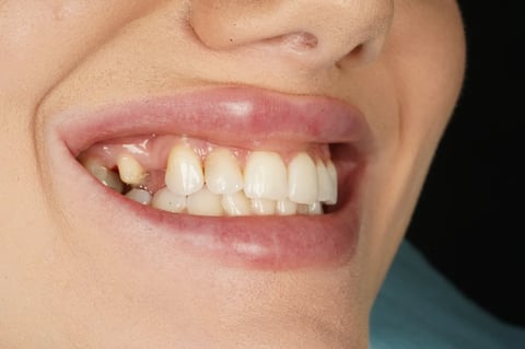 Before closing a long-standing gap with a two-unit bridge — Jamil Dental Hirwaun