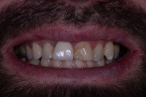 Before replacing a dark crown & restoring a chipped front tooth — Jamil Dental Hirwaun