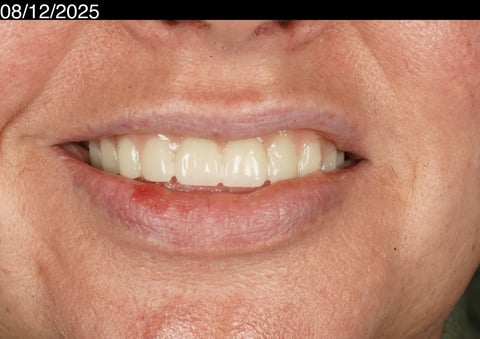 After a first smile in years — upper acrylic denture — Jamil Dental Hirwaun