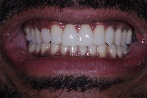 After invisalign, whitening & bonding — reshaped retained baby teeth — Jamil Dental Hirwaun