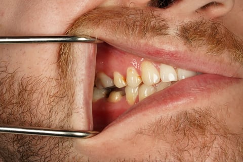Before saved & protected — molar root canal with zirconia crown — Jamil Dental Hirwaun