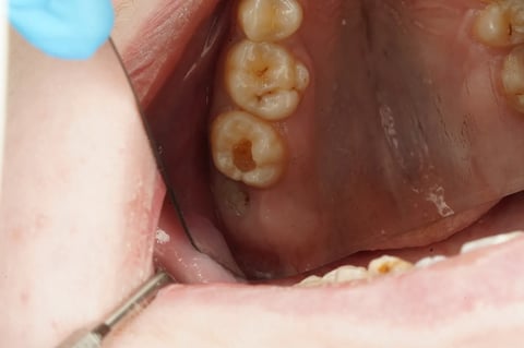 Before sensitive to bite — small cavity, composite restoration — Jamil Dental Hirwaun