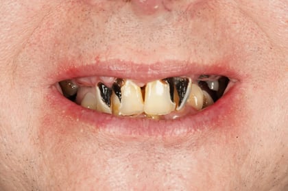 Before full mouth clearance & immediate dentures — Jamil Dental, dentist in Hirwaun