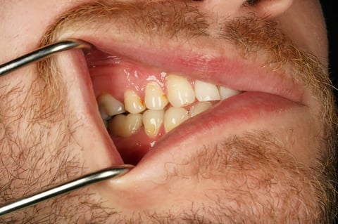 After saved & protected — molar root canal with zirconia crown — Jamil Dental Hirwaun