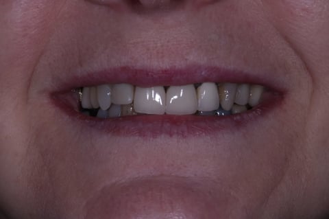 Before digital smile design — 6 layered zirconia crowns — Jamil Dental Hirwaun