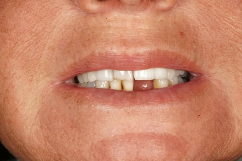 Before "nothing could be done" — small lower denture, big difference — Jamil Dental Hirwaun