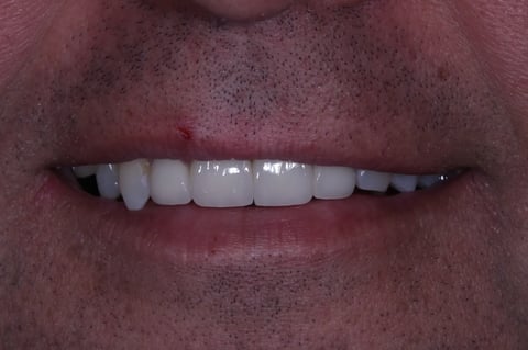 After brighter & balanced — whitening with emax crowns & veneers — Jamil Dental Hirwaun