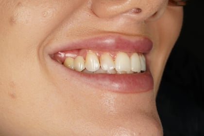 After closing a long-standing gap with a two-unit bridge — Jamil Dental, dentist in Hirwaun
