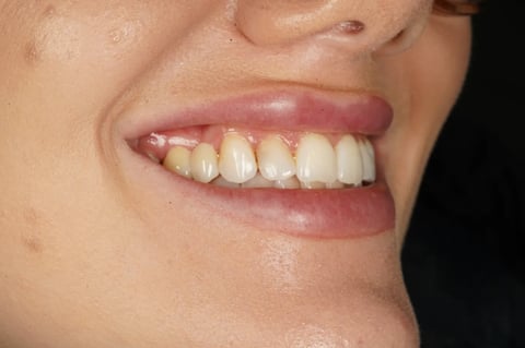 After closing a long-standing gap with a two-unit bridge — Jamil Dental Hirwaun