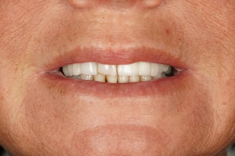 After "nothing could be done" — small lower denture, big difference — Jamil Dental Hirwaun