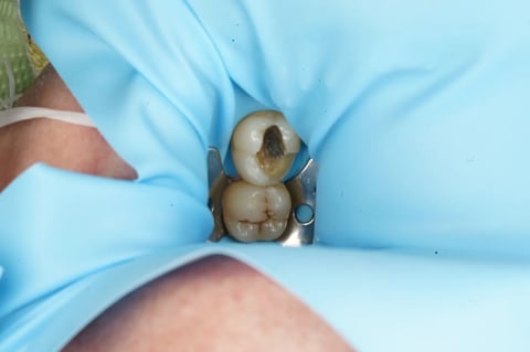 Before saving a tooth others said couldn't be saved — emax onlay — Jamil Dental Hirwaun