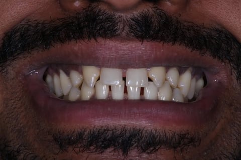 Before invisalign, whitening & bonding — reshaped retained baby teeth — Jamil Dental Hirwaun