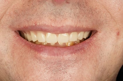 After full mouth clearance & immediate dentures — Jamil Dental, dentist in Hirwaun