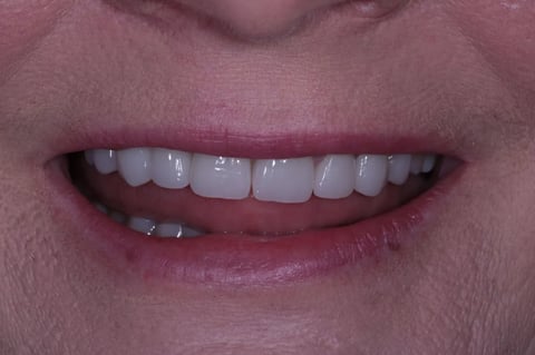 After severe wear restored — 8 zirconia crowns — Jamil Dental Hirwaun