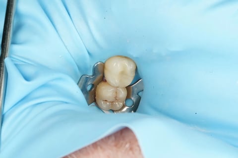 After saving a tooth others said couldn't be saved — emax onlay — Jamil Dental Hirwaun
