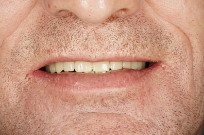 After full mouth reset — upper & lower dentures after clearance — Jamil Dental, dentist in Hirwaun