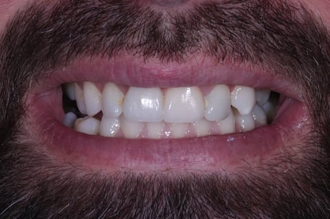 After replacing a dark crown & restoring a chipped front tooth — Jamil Dental Hirwaun