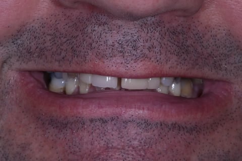 Before refreshed & rebuilt — whitening with 6 emax crowns — Jamil Dental Hirwaun