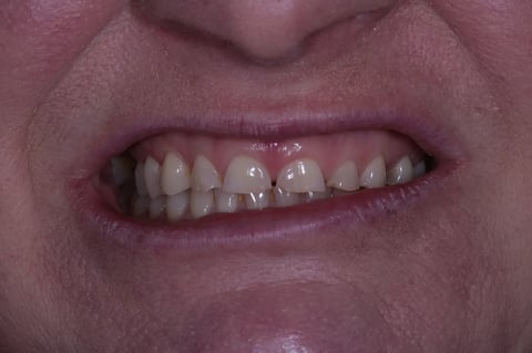 Before severe wear restored — 8 zirconia crowns — Jamil Dental Hirwaun