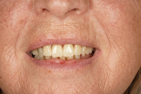 After patient-designed replacement denture — Jamil Dental Hirwaun
