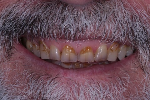 Before rebuilt & refreshed — composite bonding on 6 front teeth — Jamil Dental Hirwaun