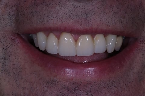 After rebuilt front teeth — whitening with zirconia crowns & bridge — Jamil Dental Hirwaun