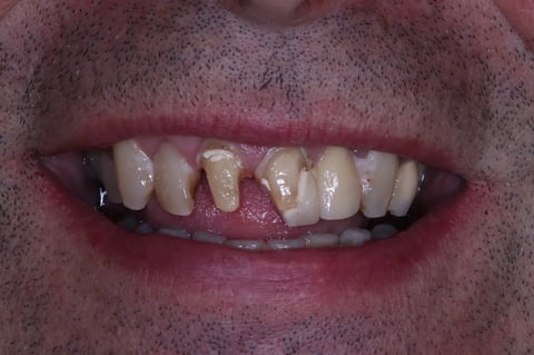 Before rebuilt front teeth — whitening with zirconia crowns & bridge — Jamil Dental Hirwaun