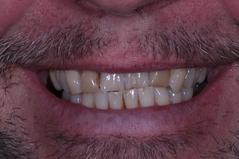Before straightened, brightened & refined — invisalign with 4 emax veneers — Jamil Dental Hirwaun