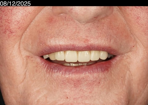 After a more secure smile — cobalt chrome denture — Jamil Dental Hirwaun
