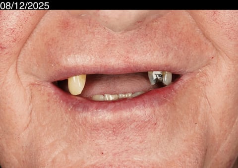 Before a more secure smile — cobalt chrome denture — Jamil Dental Hirwaun