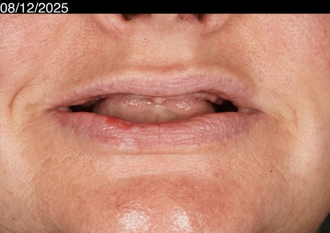 Before a first smile in years — upper acrylic denture — Jamil Dental Hirwaun