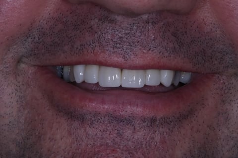 After refreshed & rebuilt — whitening with 6 emax crowns — Jamil Dental Hirwaun