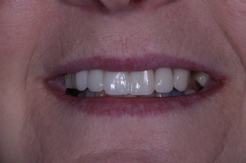 After digital smile design — 6 layered zirconia crowns — Jamil Dental Hirwaun
