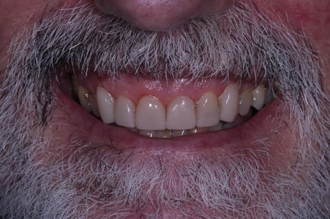 After rebuilt & refreshed — composite bonding on 6 front teeth — Jamil Dental Hirwaun