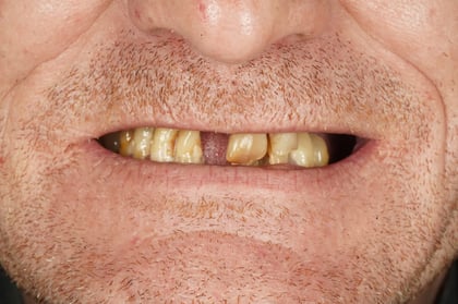 Before full mouth reset — upper & lower dentures after clearance — Jamil Dental, dentist in Hirwaun