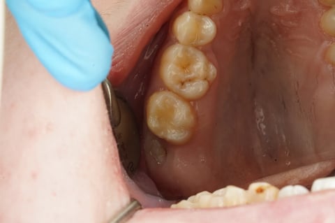 After sensitive to bite — small cavity, composite restoration — Jamil Dental Hirwaun